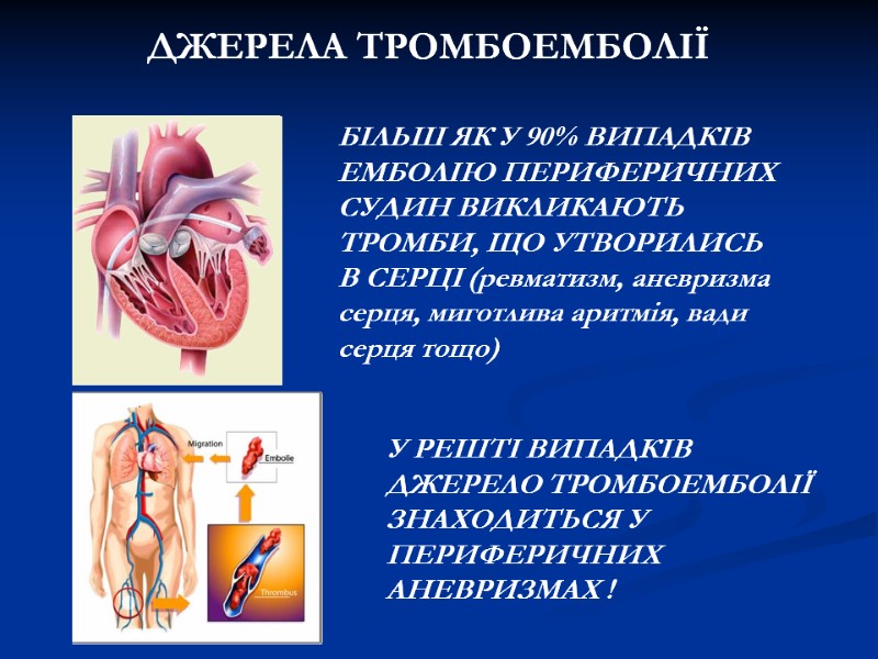 ДЖЕРЕЛА ТРОМБОЕМБОЛІЇ БІЛЬШ ЯК У 90% ВИПАДКІВ ЕМБОЛІЮ ПЕРИФЕРИЧНИХ СУДИН ВИКЛИКАЮТЬ ТРОМБИ, ЩО ДЖЕРЕЛА ТРОМБОЕМБОЛІЇ БІЛЬШ ЯК У 90% ВИПАДКІВ ЕМБОЛІЮ ПЕРИФЕРИЧНИХ СУДИН ВИКЛИКАЮТЬ ТРОМБИ, ЩО